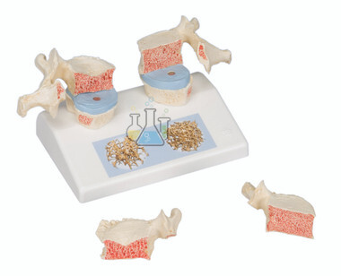 Osteoporosis Model Premium